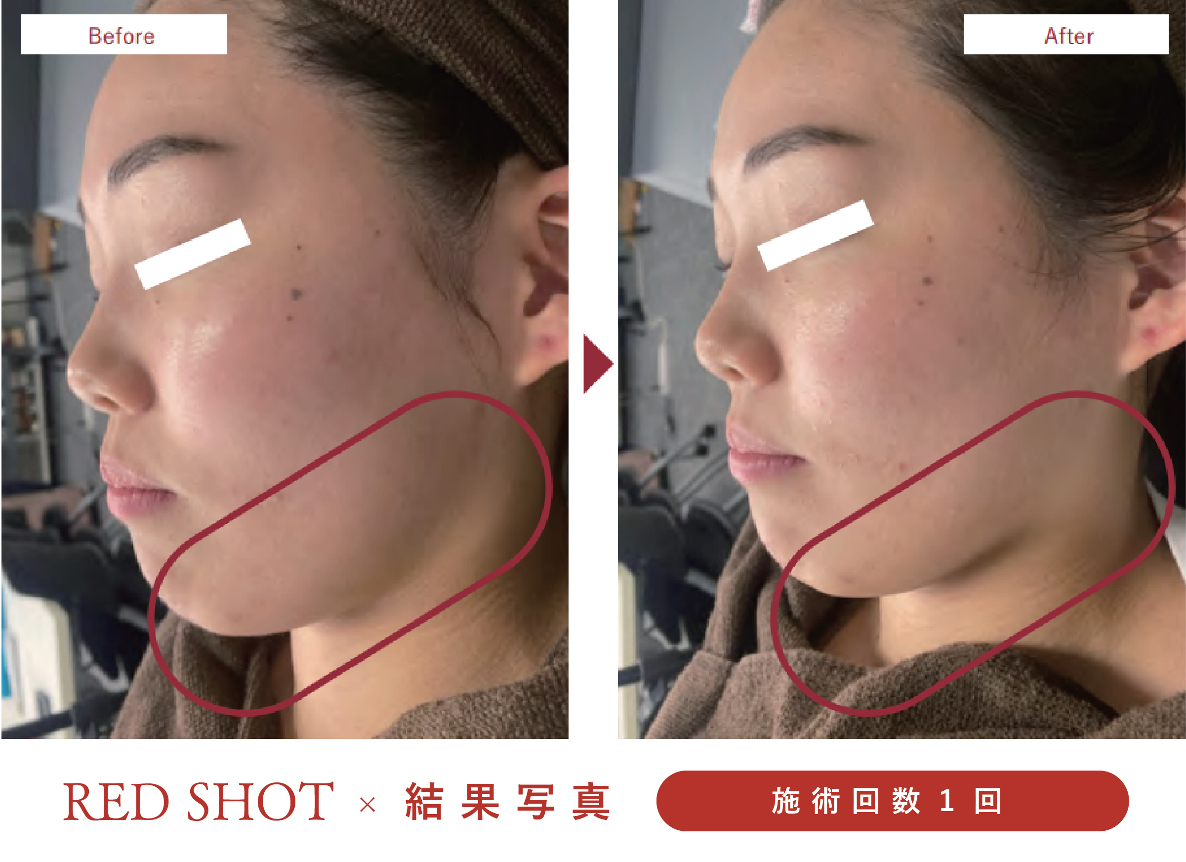 韓国発【RED SHOT 完全ガイド】脂肪溶解レッドショットとは？成分 