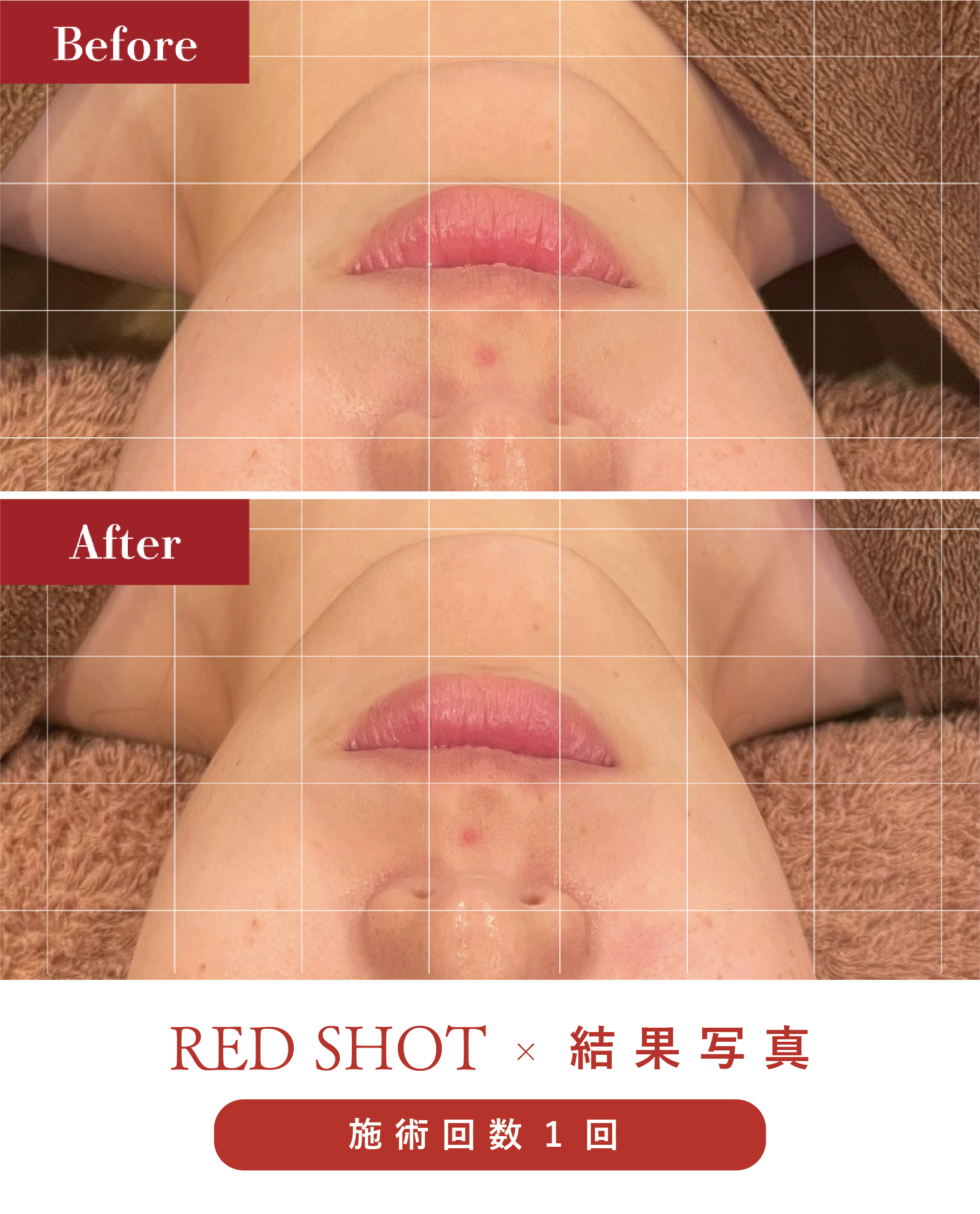 結果写真あり】RED SHOT(レッドショット)×プラズマ施術の効果を徹底紹介