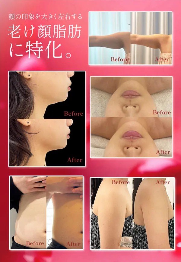 脂肪溶解美容液、レッドショット、ビフォーアフター写真