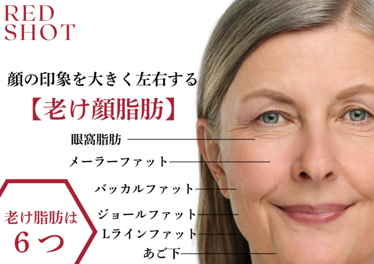 「RED SHOT(レッドショット)」老け顔脂肪は6つあります。眼窩脂肪、ジョールファット、メーラーファット、バッカルファット、Lラインファット、あご下に脂肪がある事で老けて見えます。