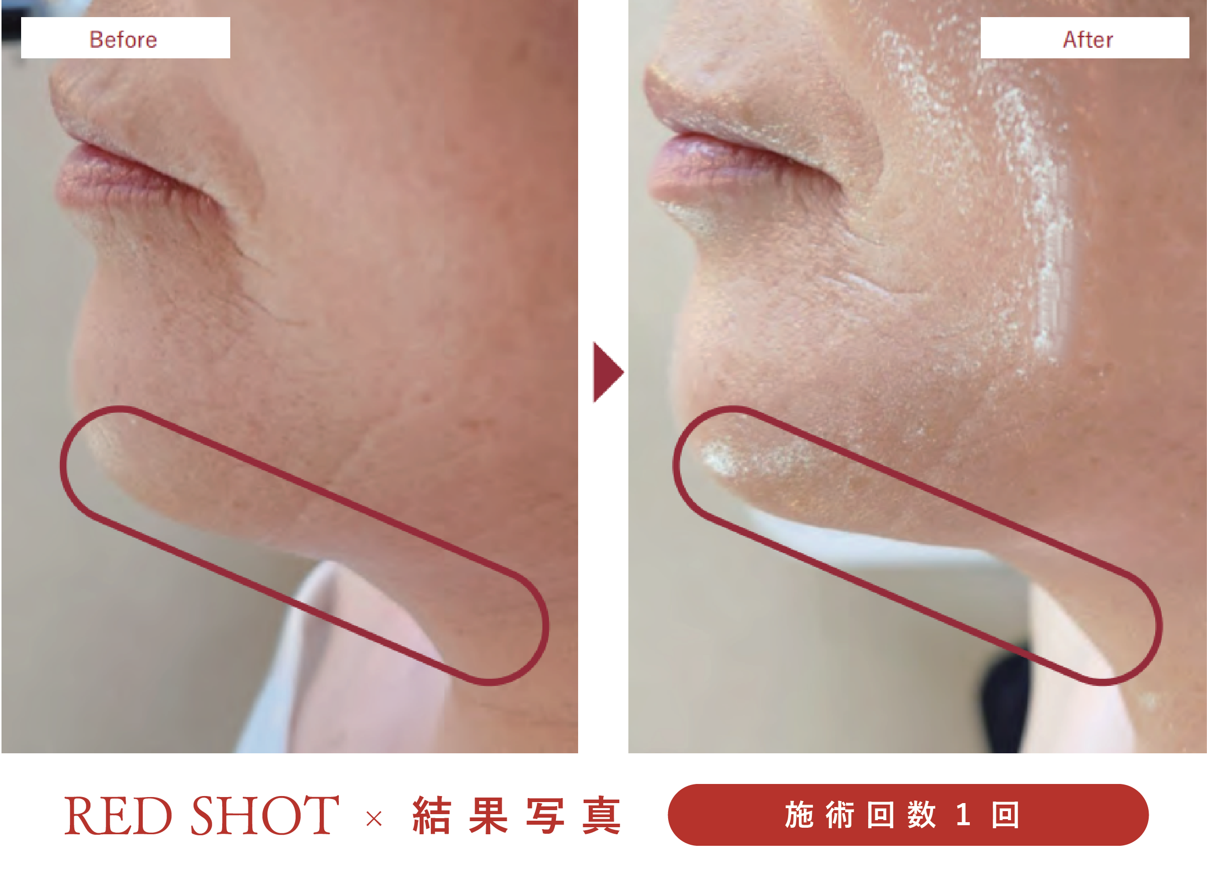 脂肪溶解美容液、レッドショット、ビフォーアフター写真、フェイスライン形成、たるみ解消