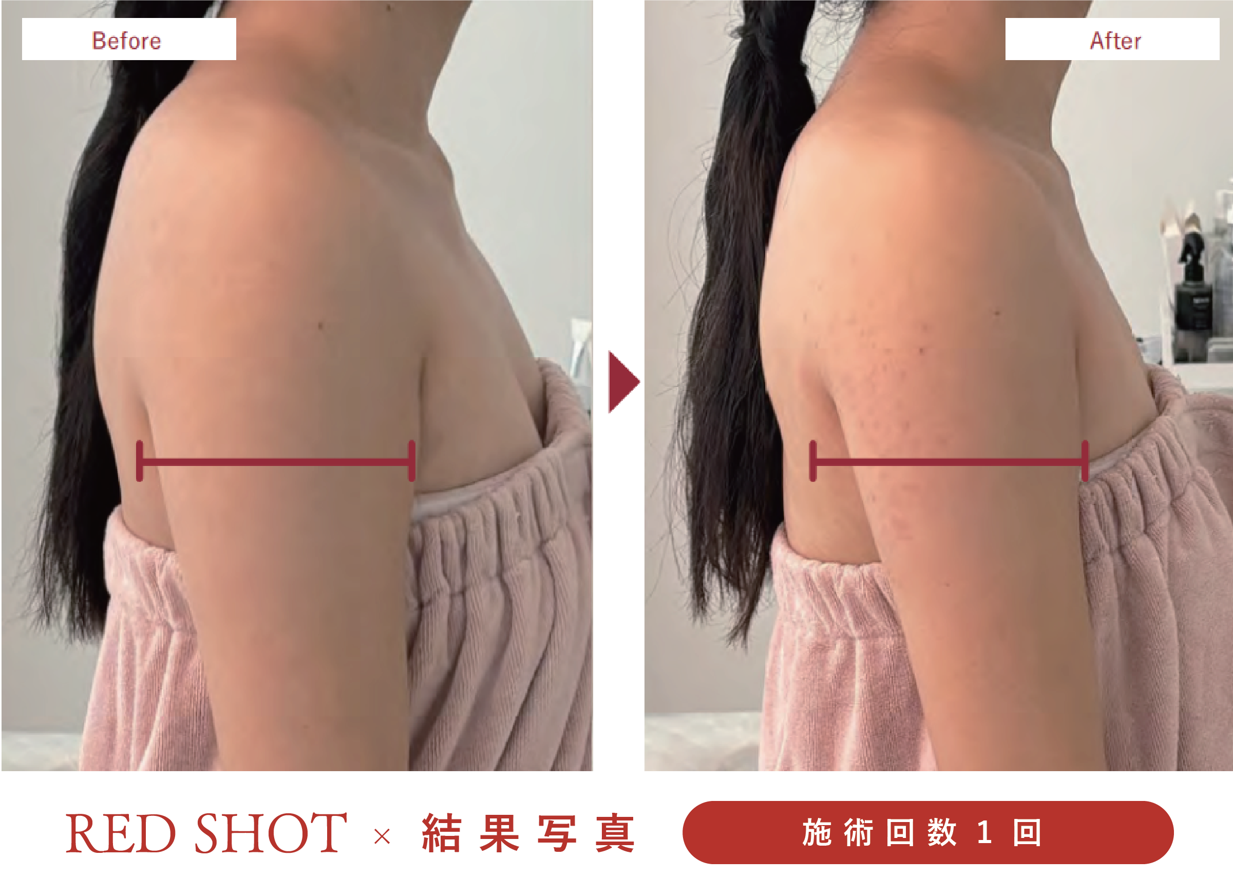 脂肪溶解美容液、レッドショット、ビフォーアフター写真、二の腕痩せ、部分痩せ
