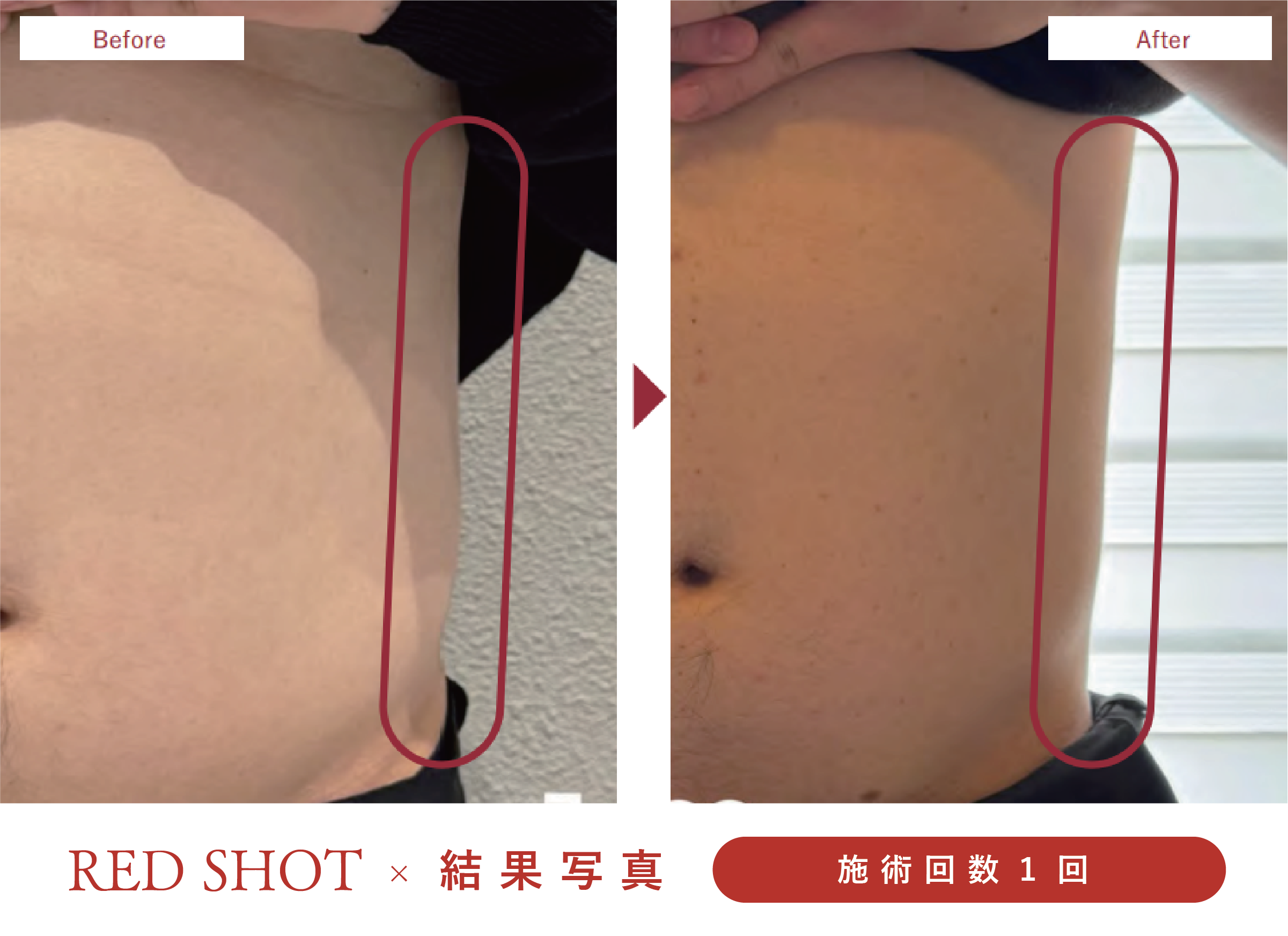 脂肪溶解美容液、レッドショット、ビフォーアフター写真、お腹痩せ、部分痩せ
