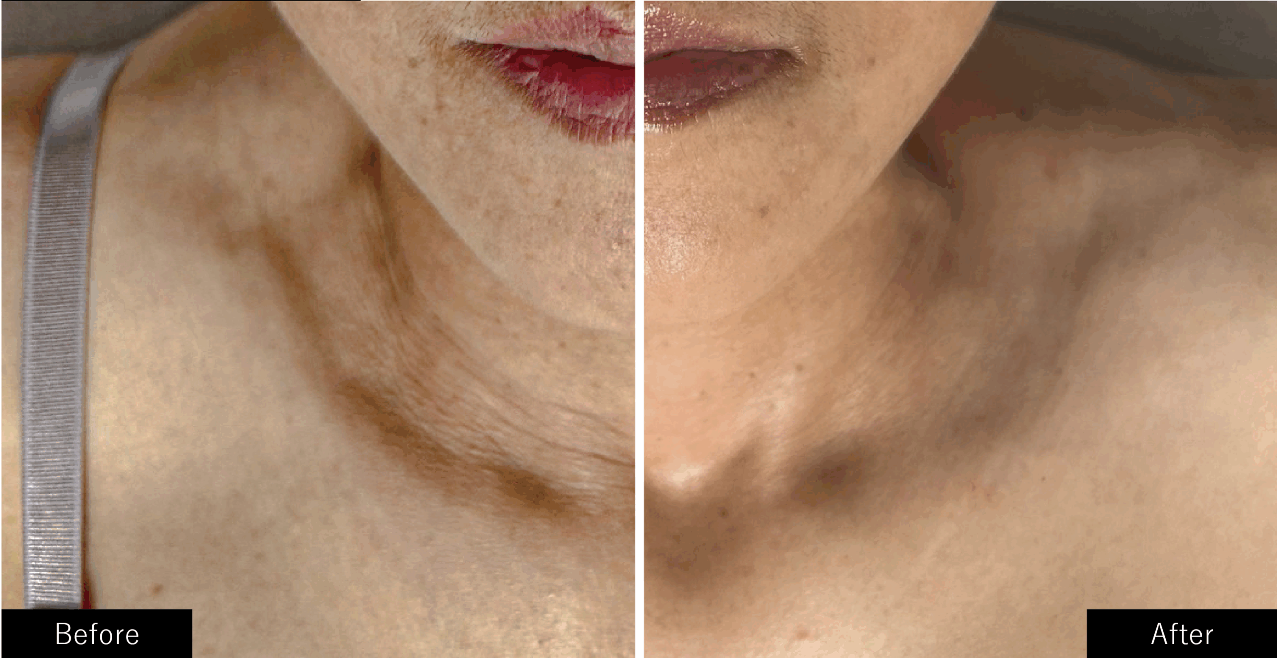 プラズマスターのシワ施術結果写真