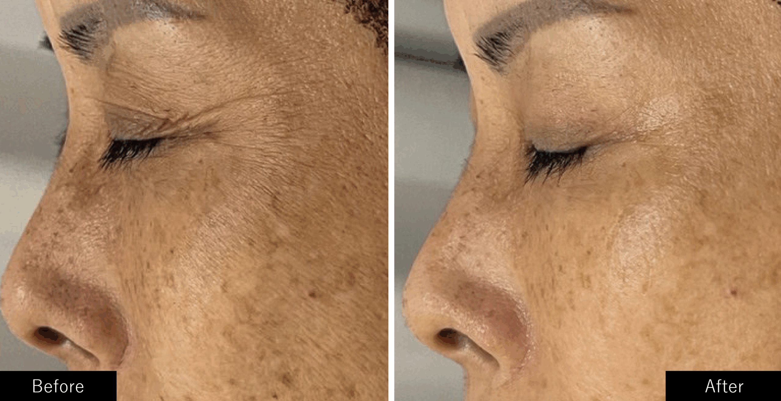 プラズマスターの目元のシワの施術結果写真