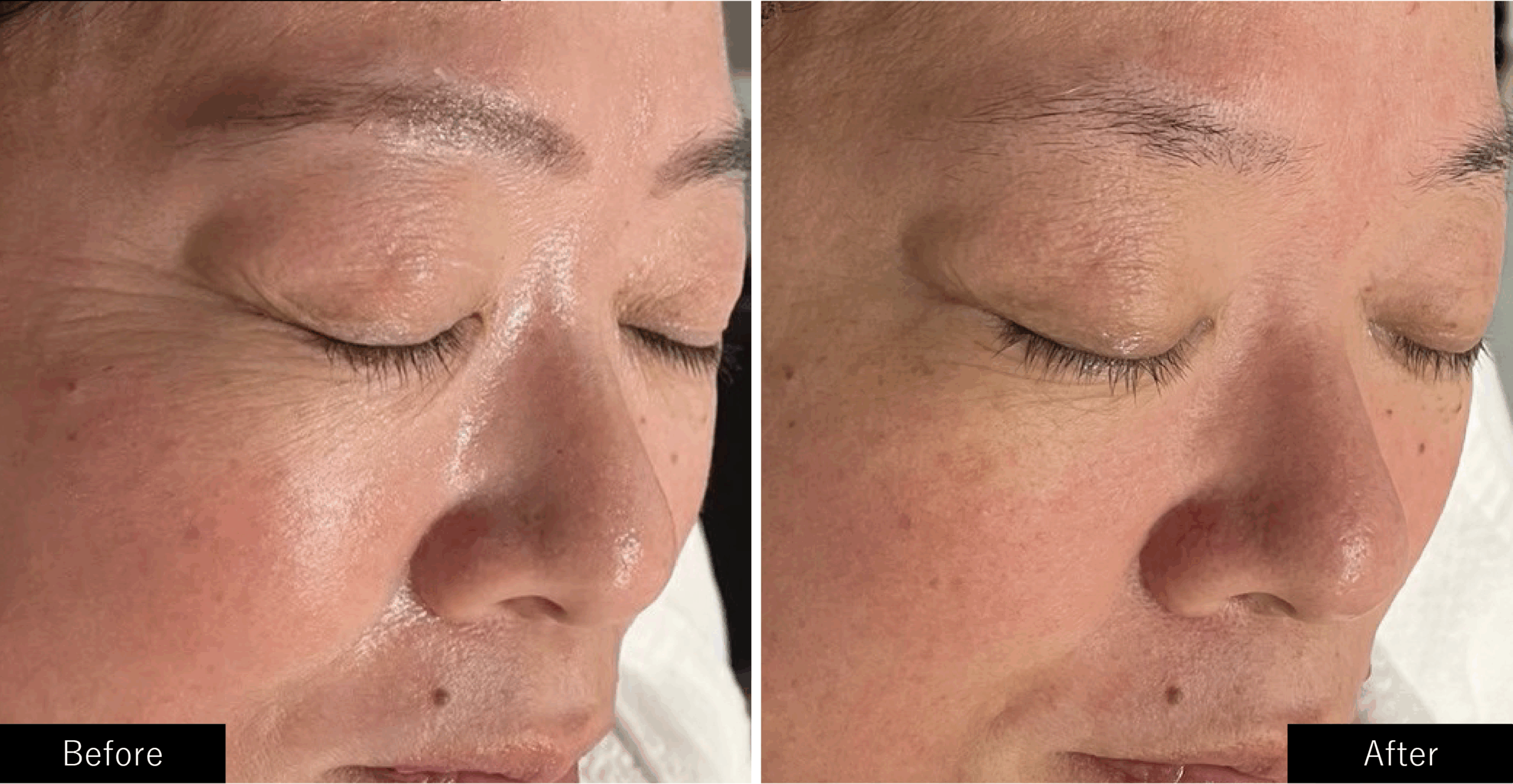 プラズマスターの毛穴の皮脂の施術結果写真