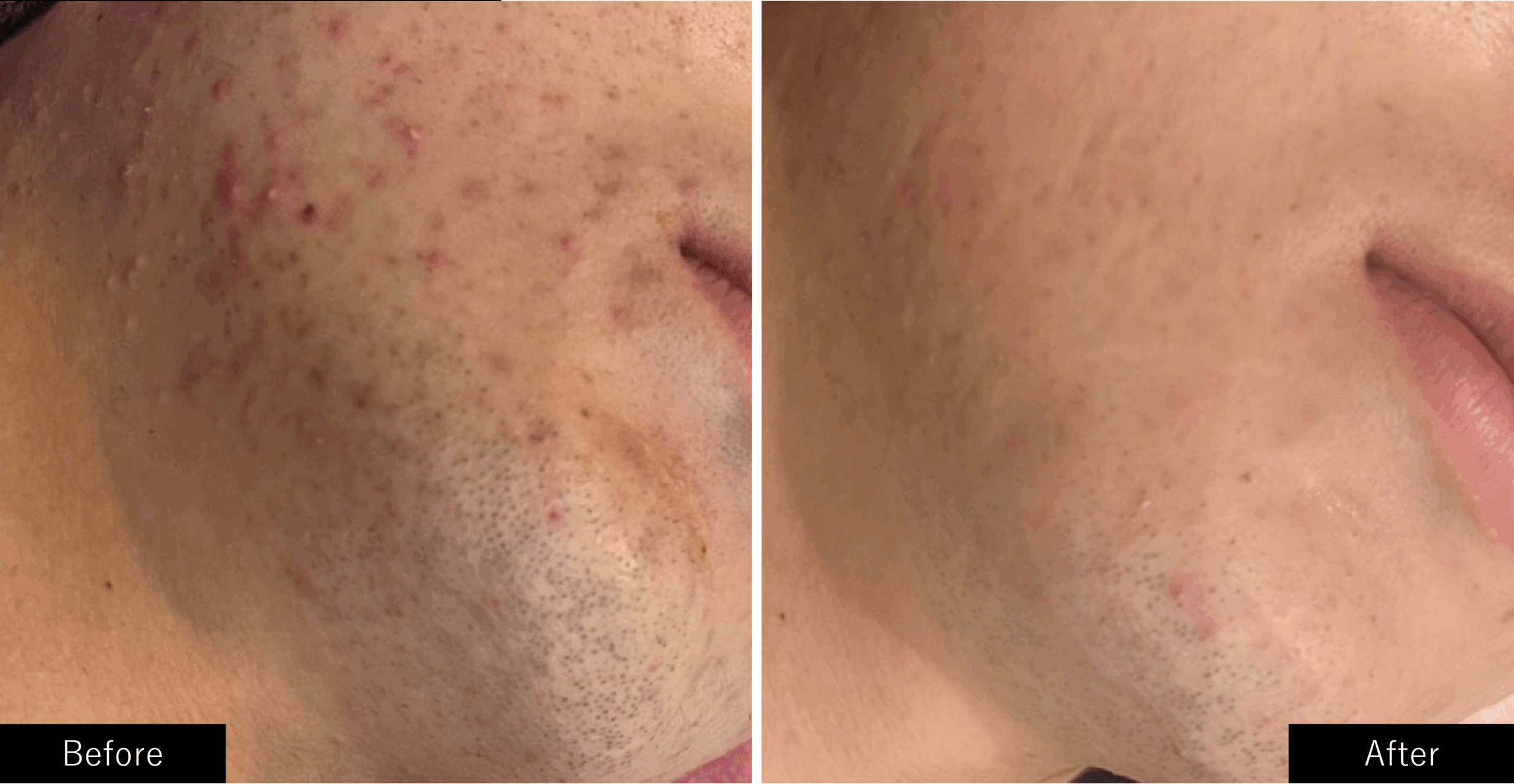 プラズマスターの毛穴の皮脂の施術結果写真 男性