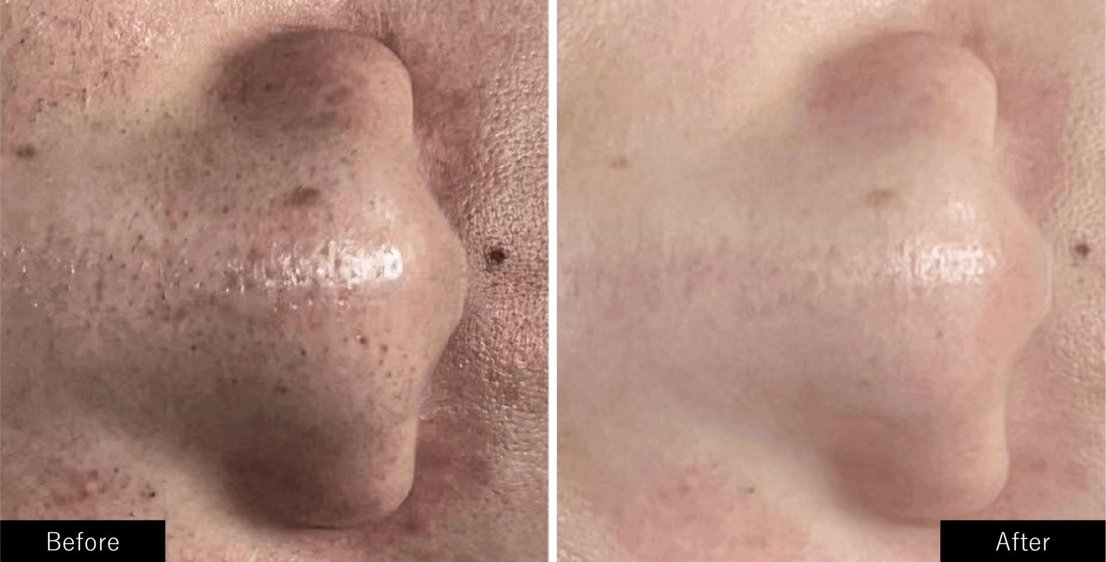 プラズマスターの鼻の角栓の施術結果写真