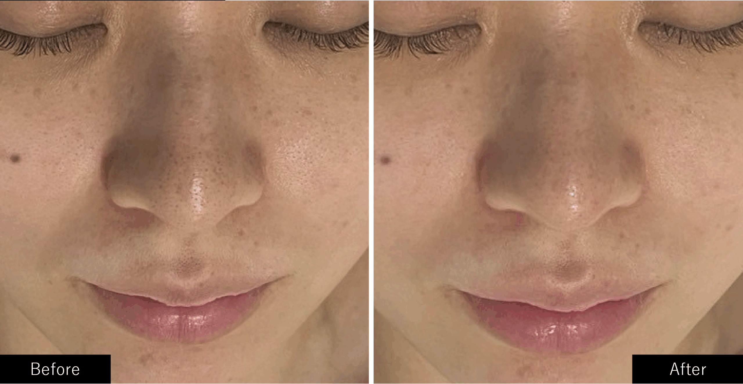 プラズマスターの毛穴の黒ずみの施術結果写真