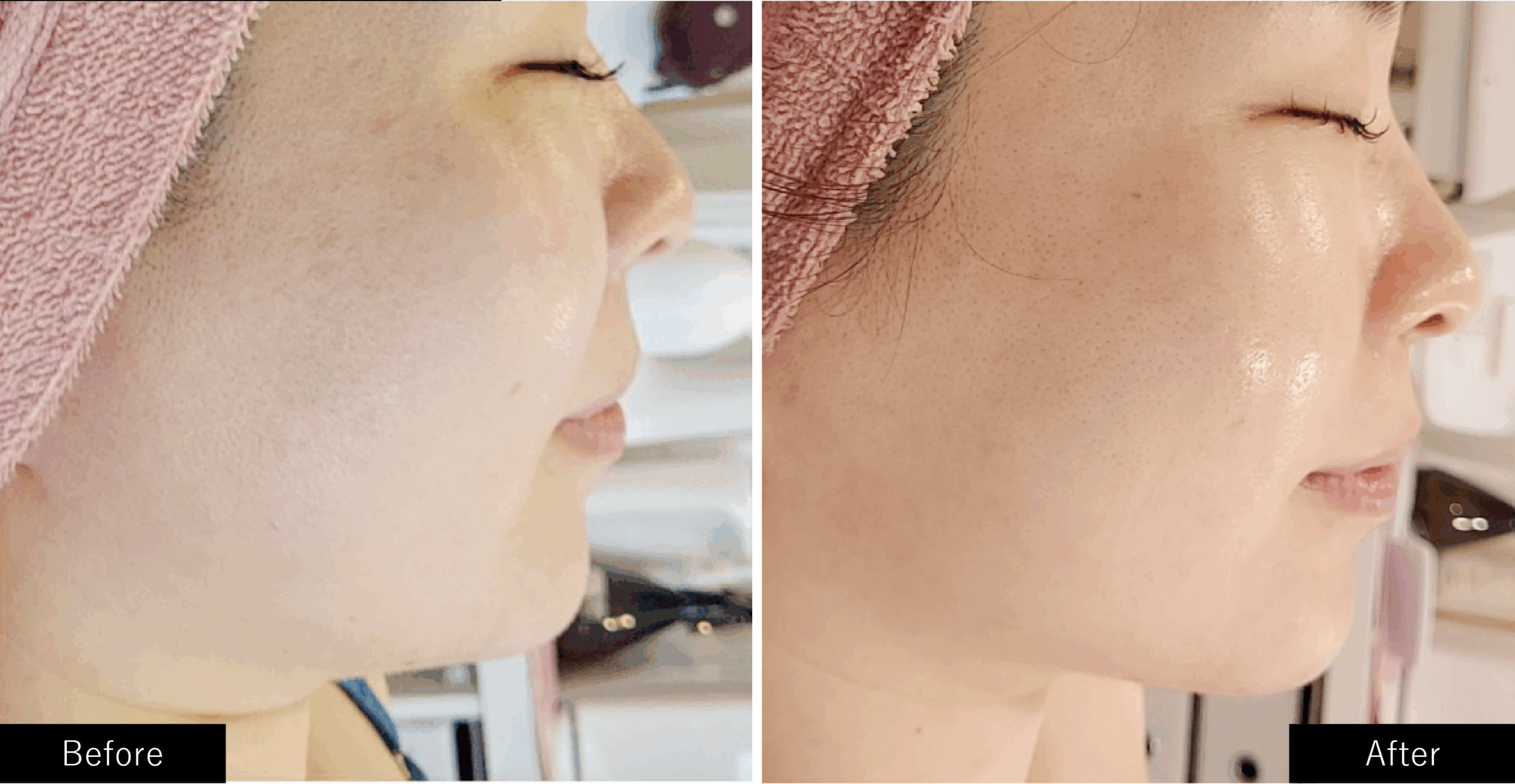 プラズマスターのリフトアップの施術結果写真