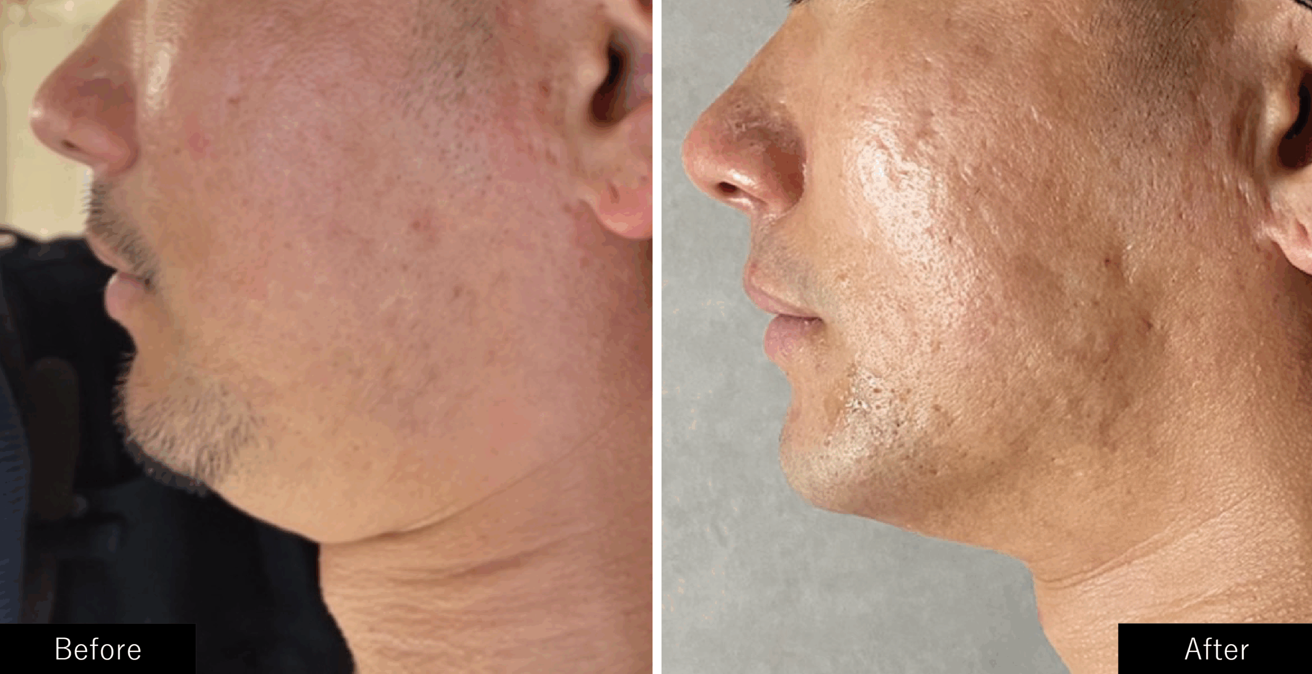 プラズマスターのリフトアップの施術結果写真　男性