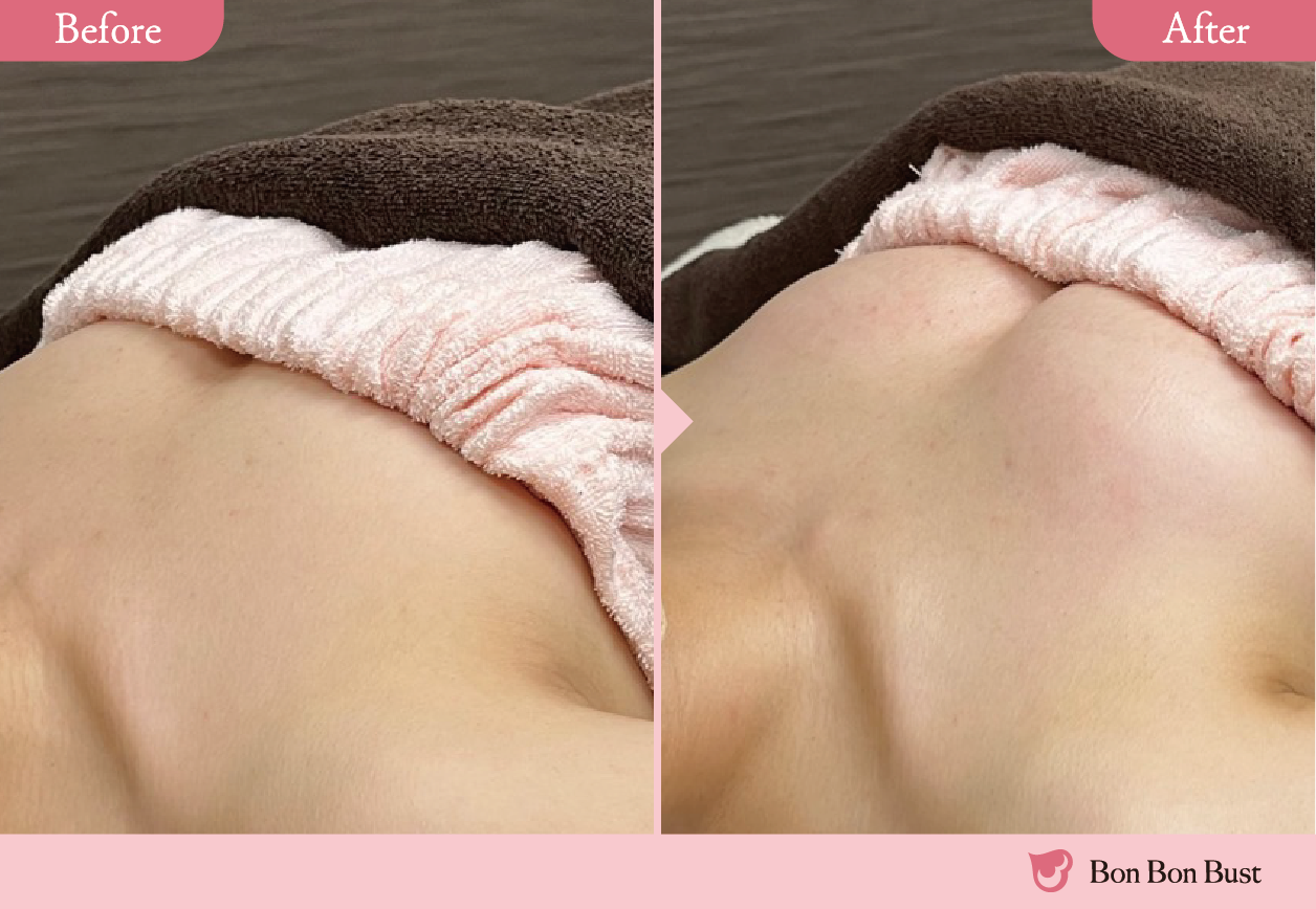 ボンボンバストの施術結果写真1