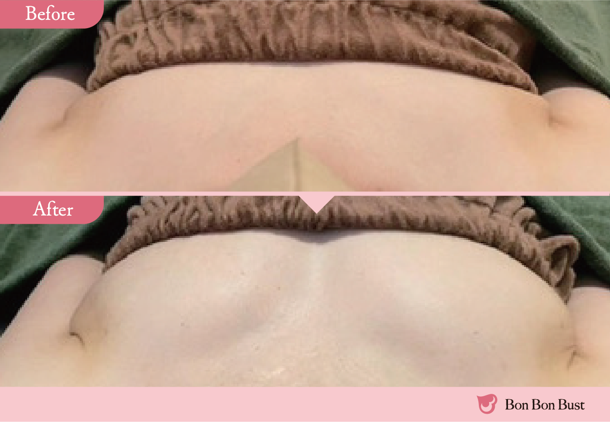 ボンボンバストの施術結果写真10