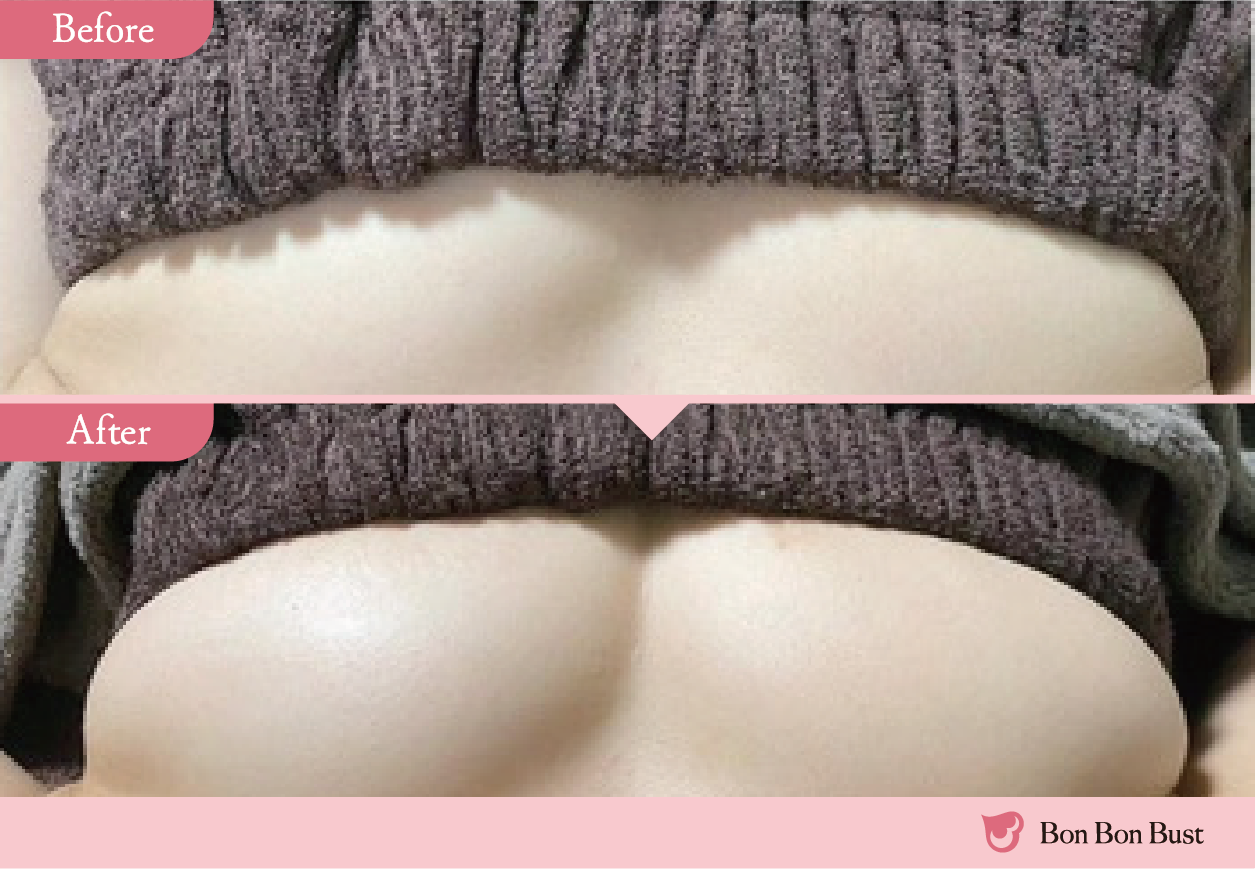 ボンボンバストの施術結果写真11