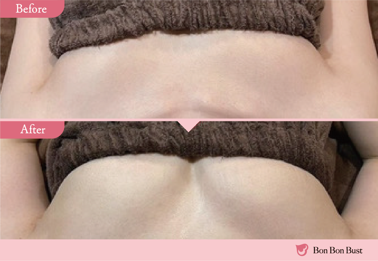 ボンボンバストの施術結果写真12