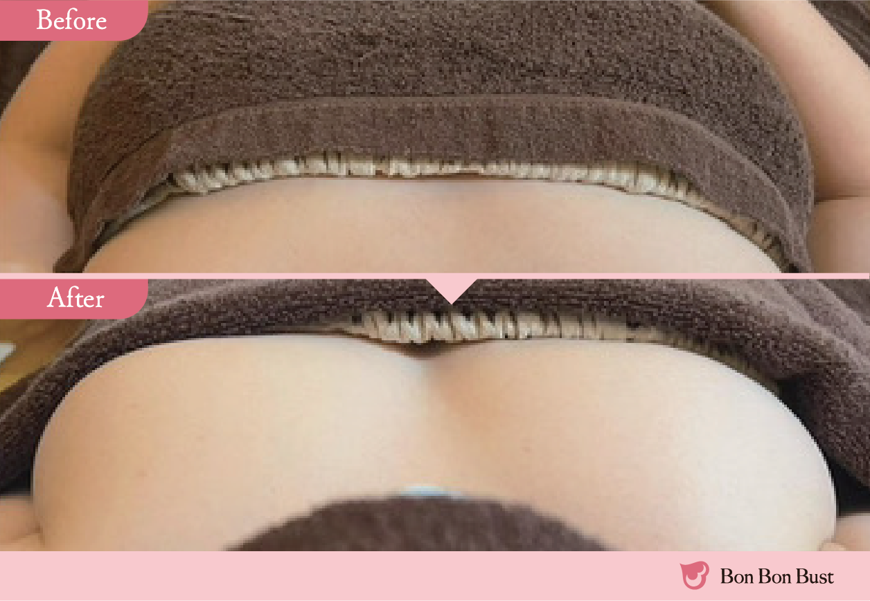 ボンボンバストの施術結果写真13