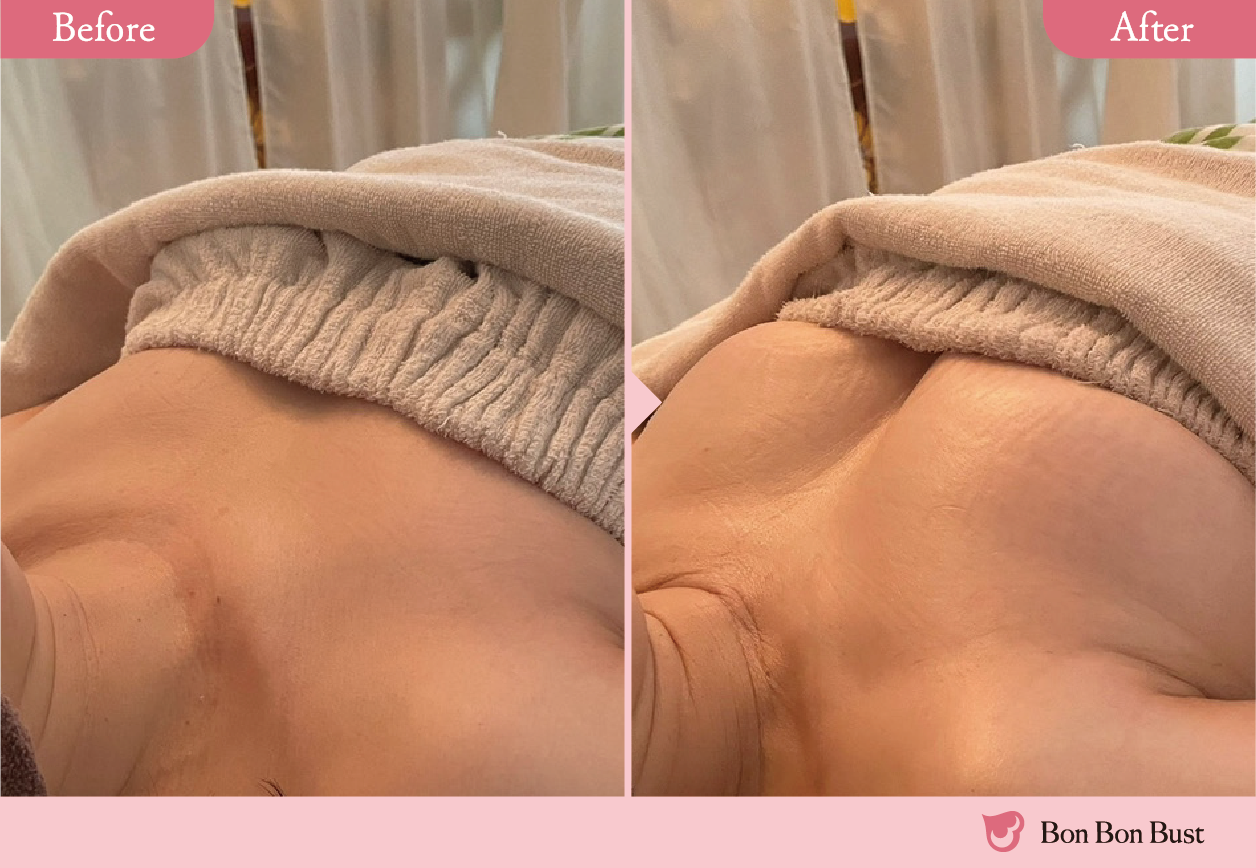 ボンボンバストの施術結果写真2