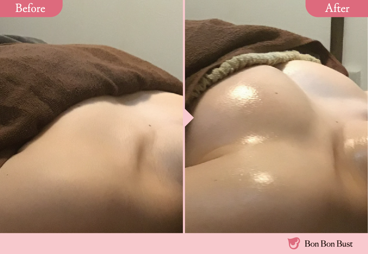 ボンボンバストの施術結果写真3