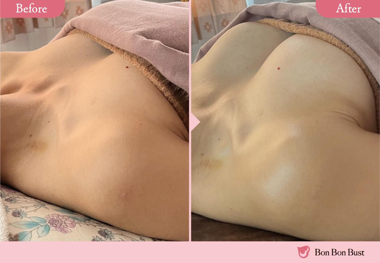 ボンボンバストの施術結果写真4