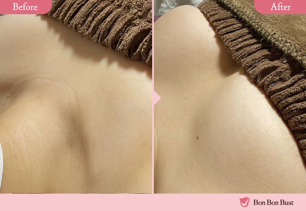 ボンボンバストの施術結果写真5