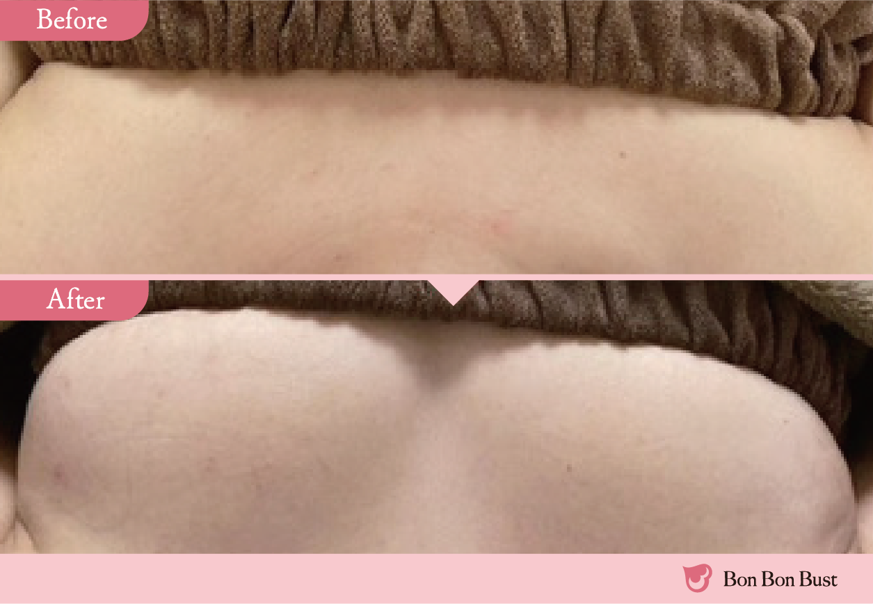 ボンボンバストの施術結果写真6