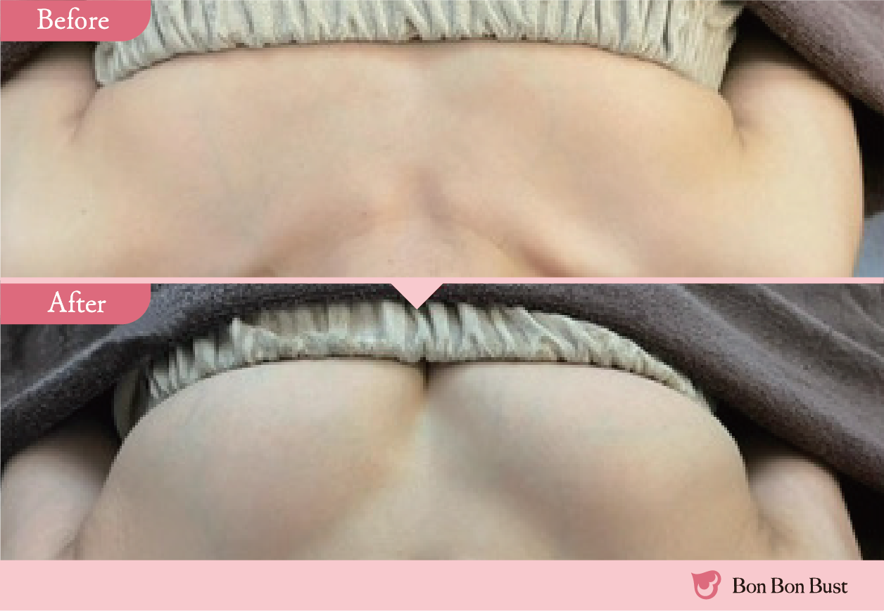 ボンボンバストの施術結果写真7