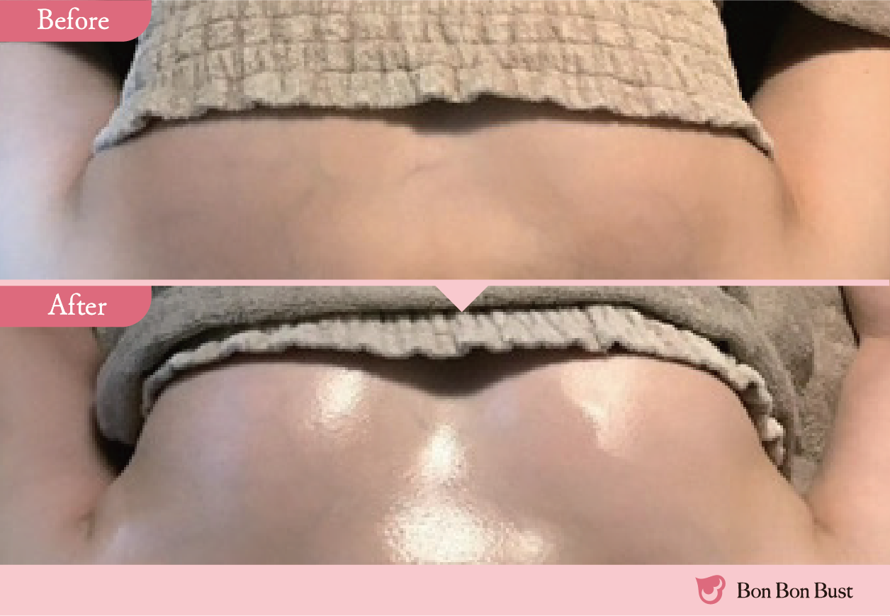 ボンボンバストの施術結果写真8