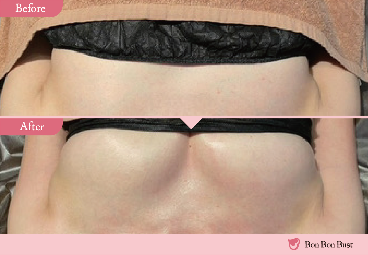 ボンボンバストの施術結果写真9