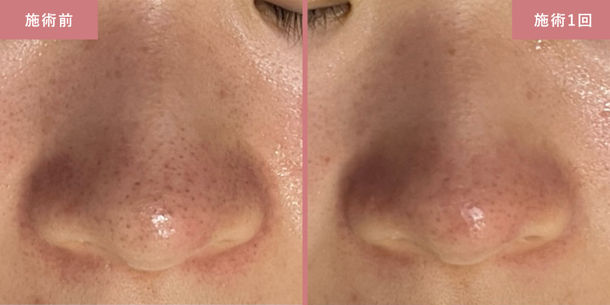 毛穴洗浄とプラズマスターの施術結果写真1