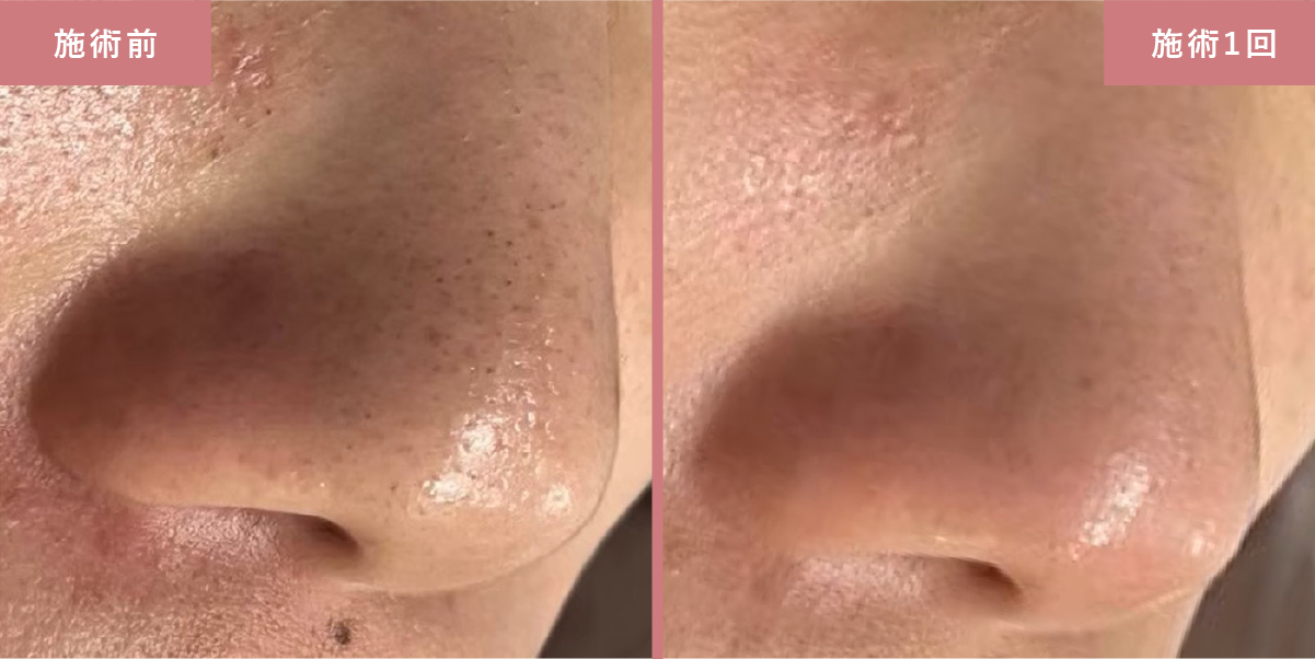 毛穴洗浄とプラズマスターの施術結果写真2