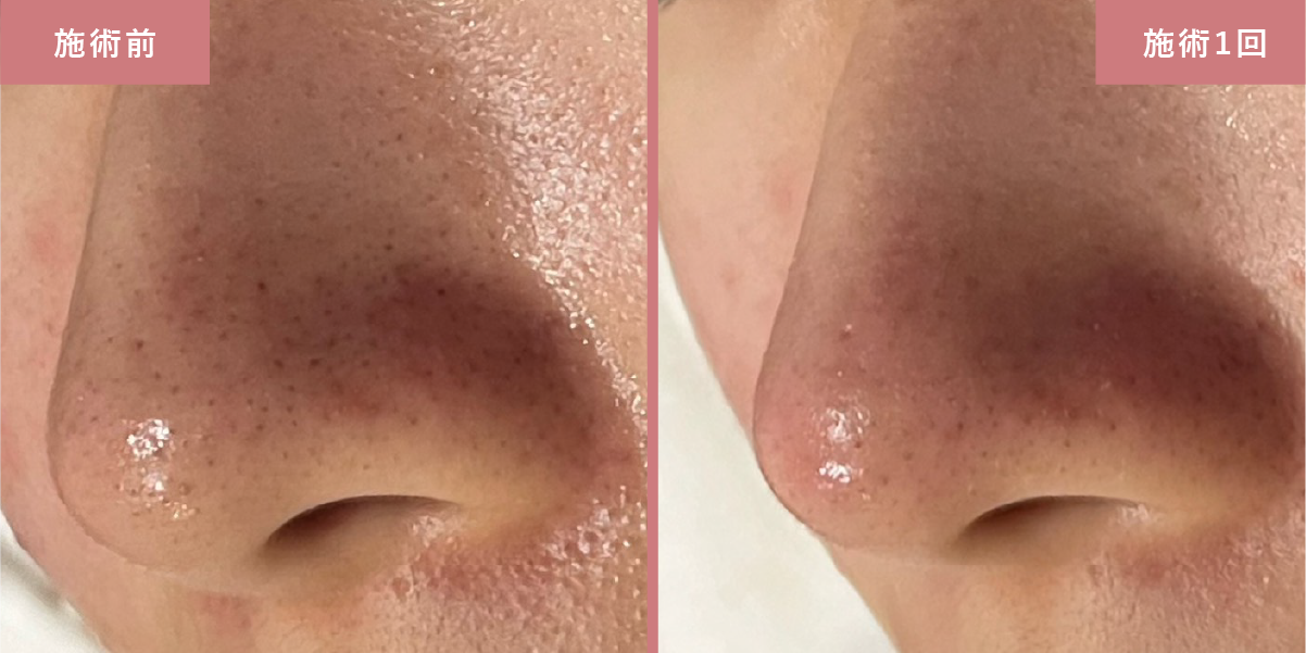 毛穴洗浄とプラズマスターの施術結果写真3