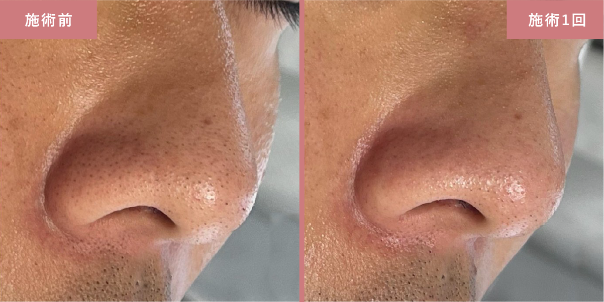 毛穴洗浄とプラズマスターの施術結果写真6