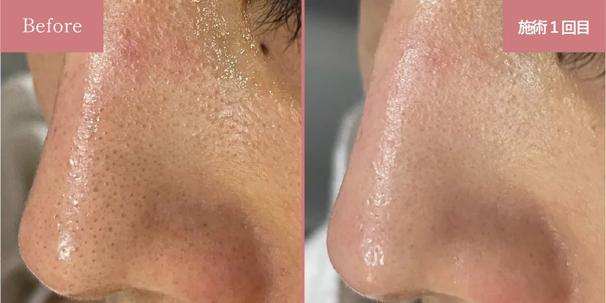 PLASMASTAR（プラズマスター）と毛穴洗浄メニューのかけ合わせ症例②