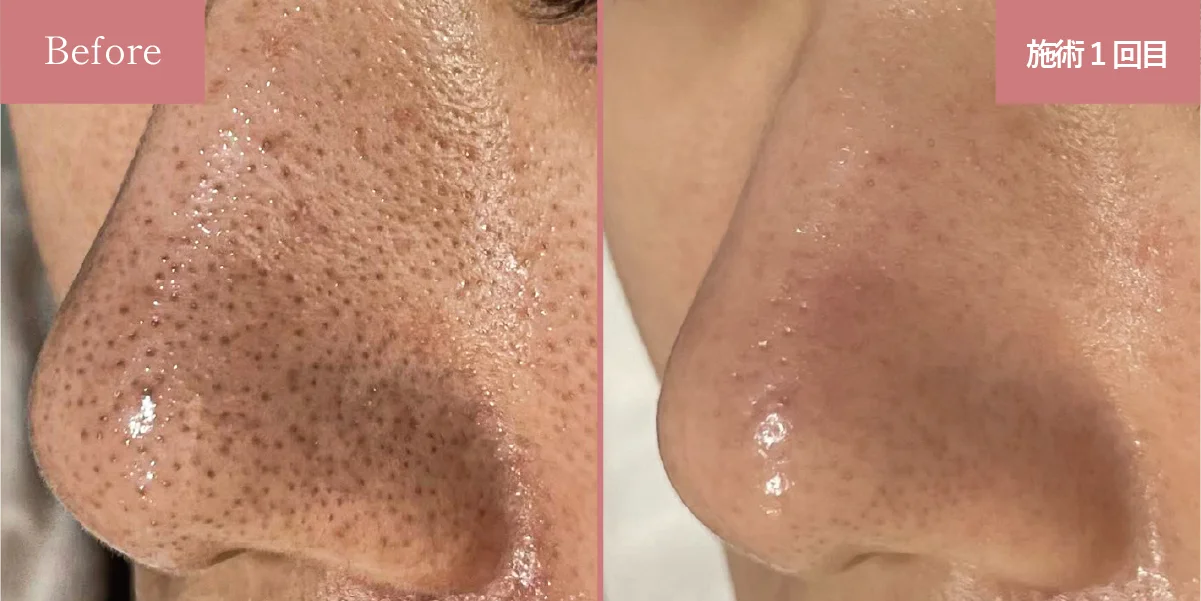 PLASMASTAR（プラズマスター）と毛穴洗浄メニューのかけ合わせ症例①