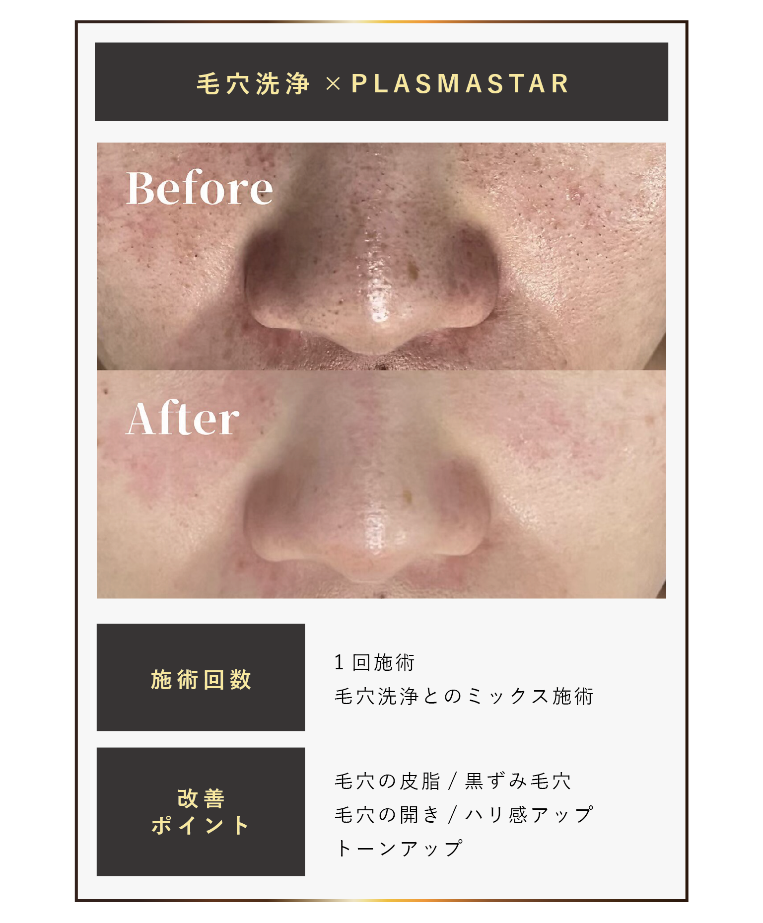 最新プラズママシンプラズマスター、毛穴のビフォーアフター写真