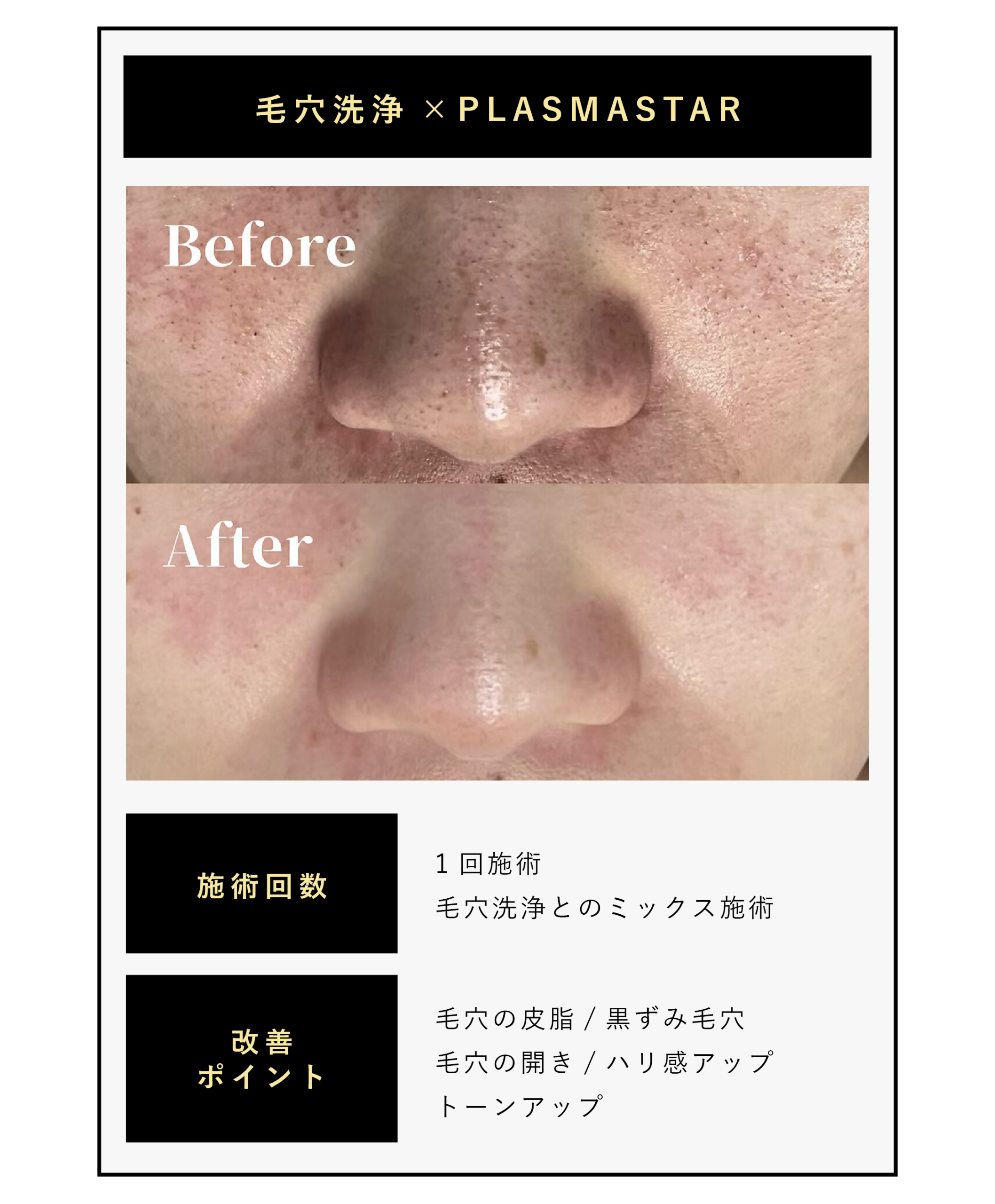 最新プラズママシンプラズマスター、毛穴のビフォーアフター写真