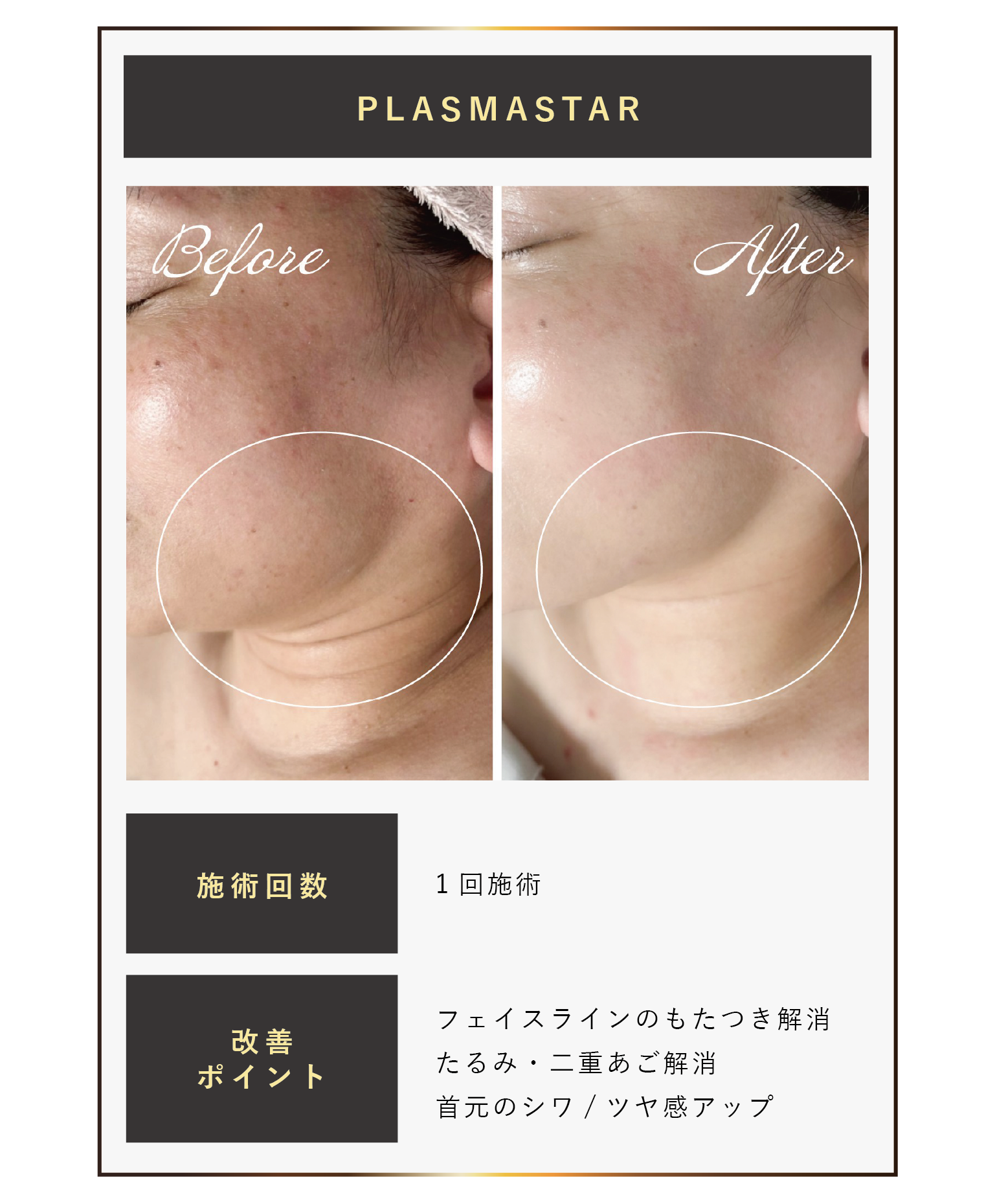 最新プラズママシンプラズマスター、首のシワ、リフトアップのビフォーアフター写真