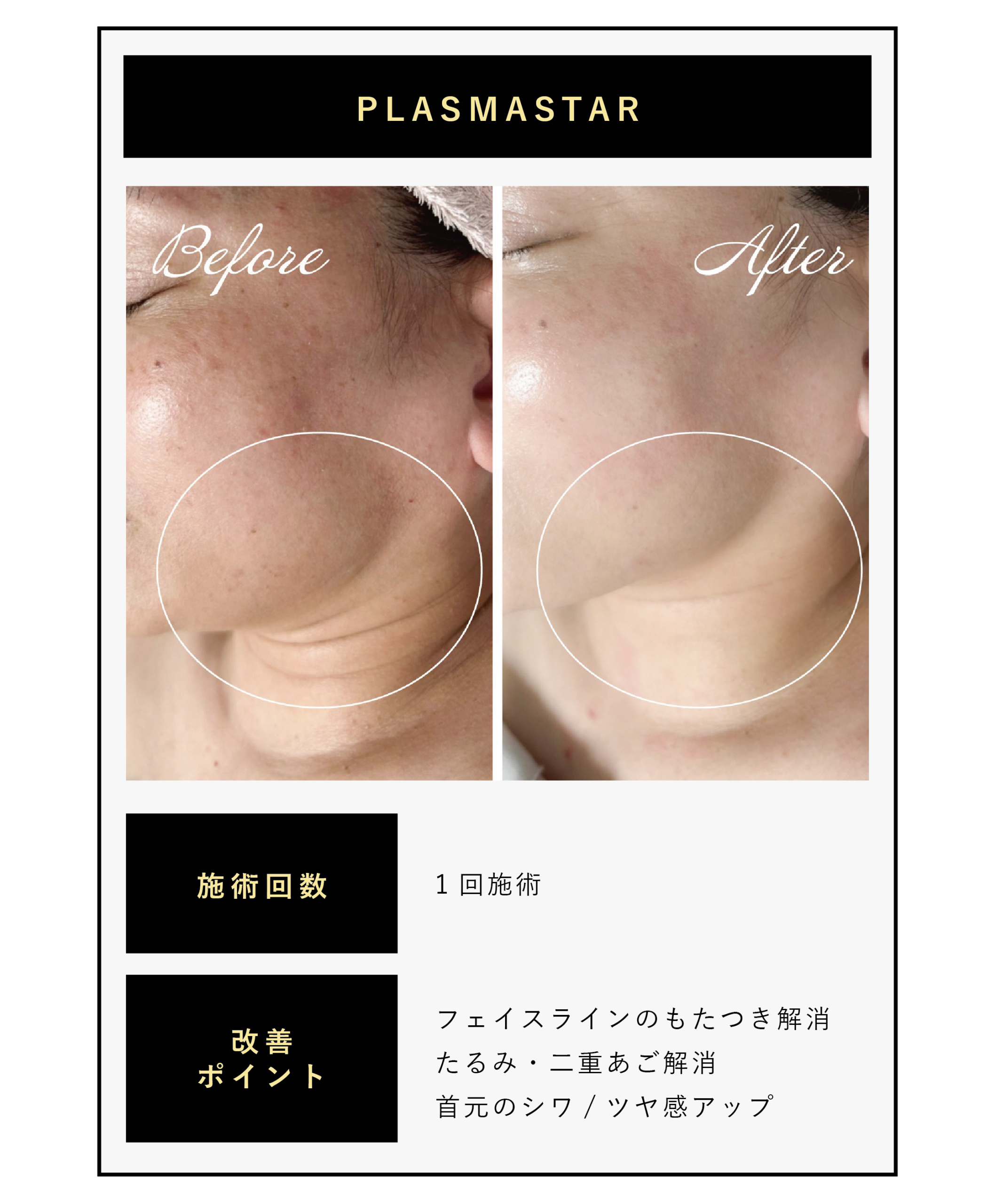 最新プラズママシンプラズマスター、首のシワ、リフトアップのビフォーアフター写真