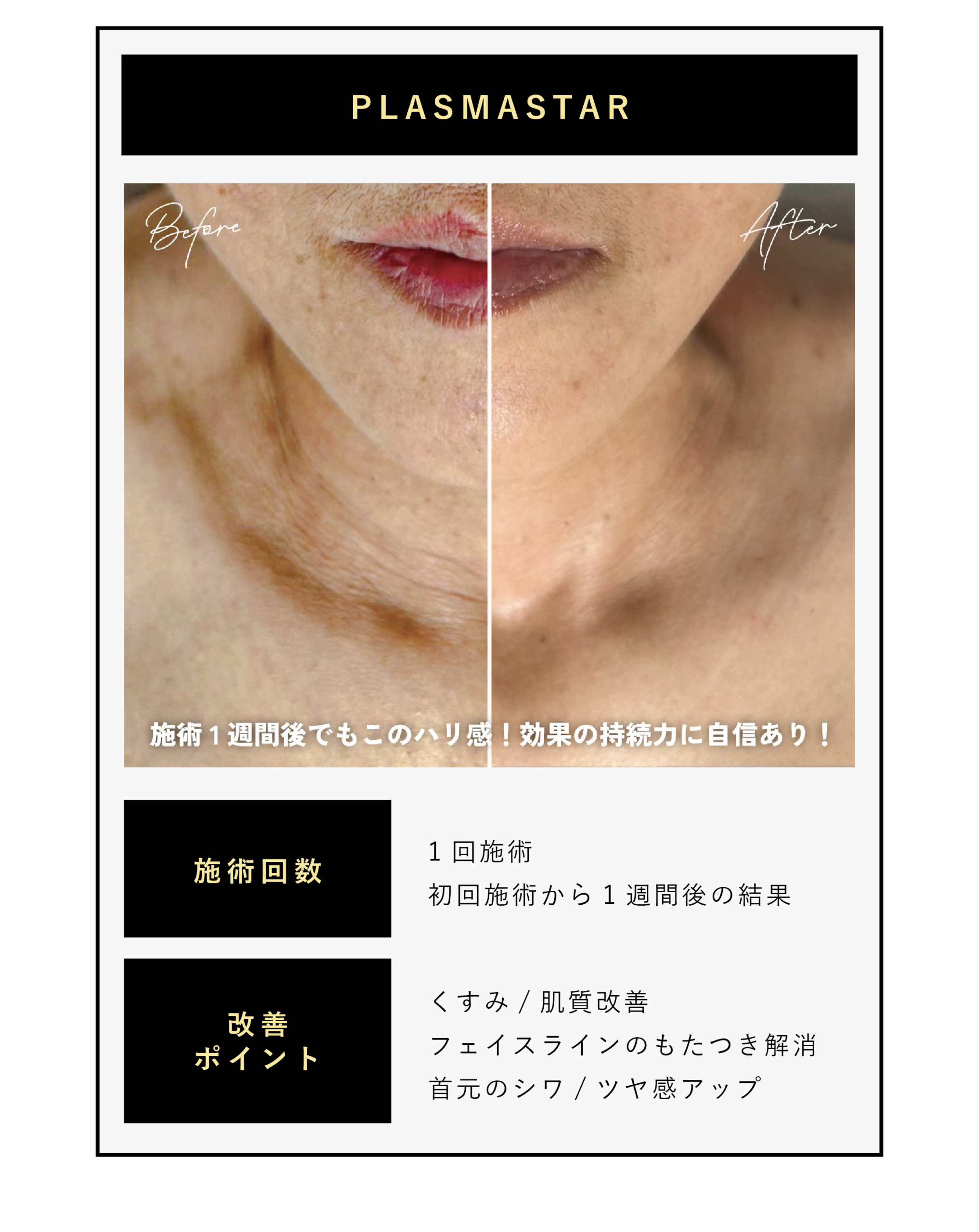 最新プラズママシンプラズマスター、首のシワ、効果の持続性が分かるビフォーアフター写真