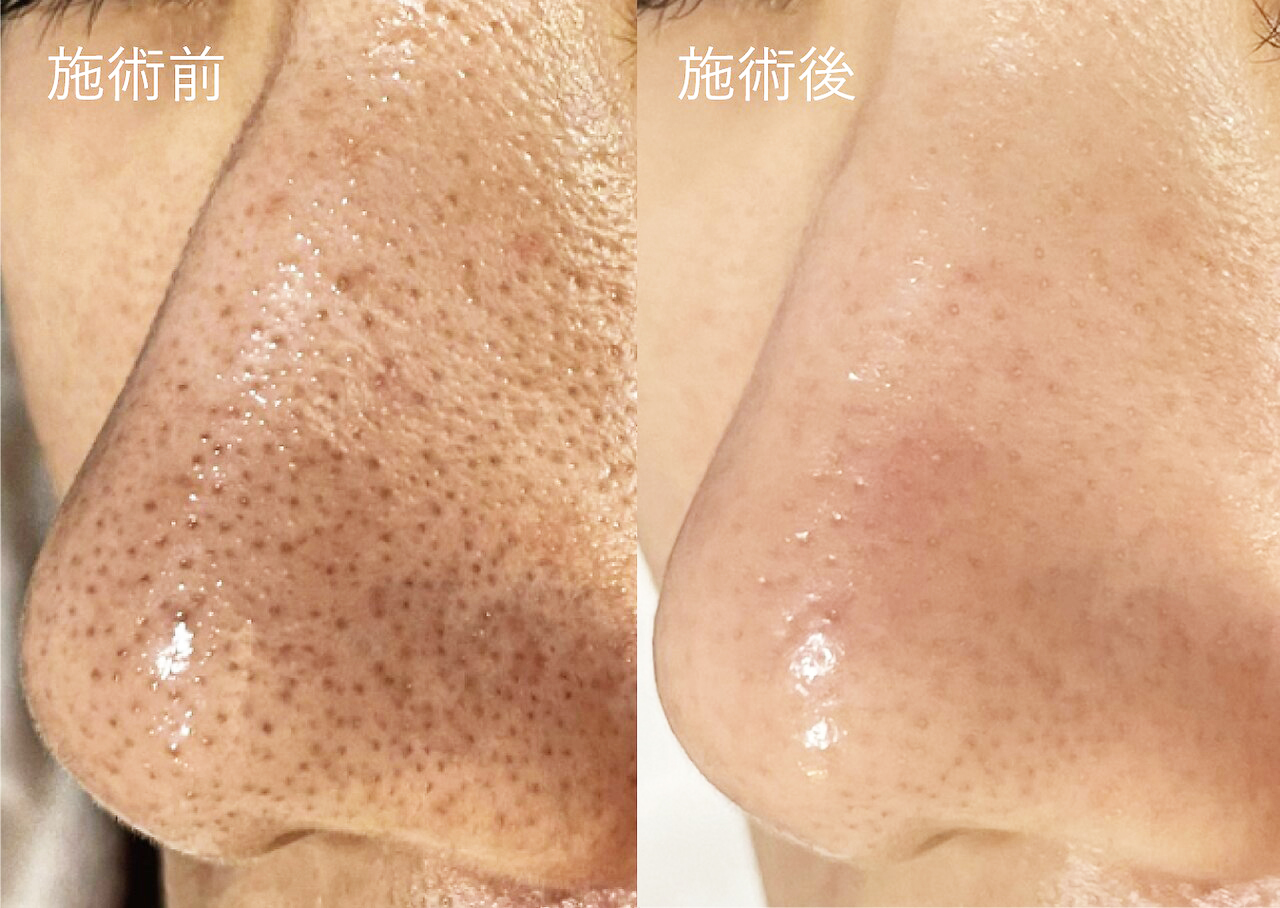 小鼻の毛穴の施術前後の一例（仕上がり・実感には個人差があります）