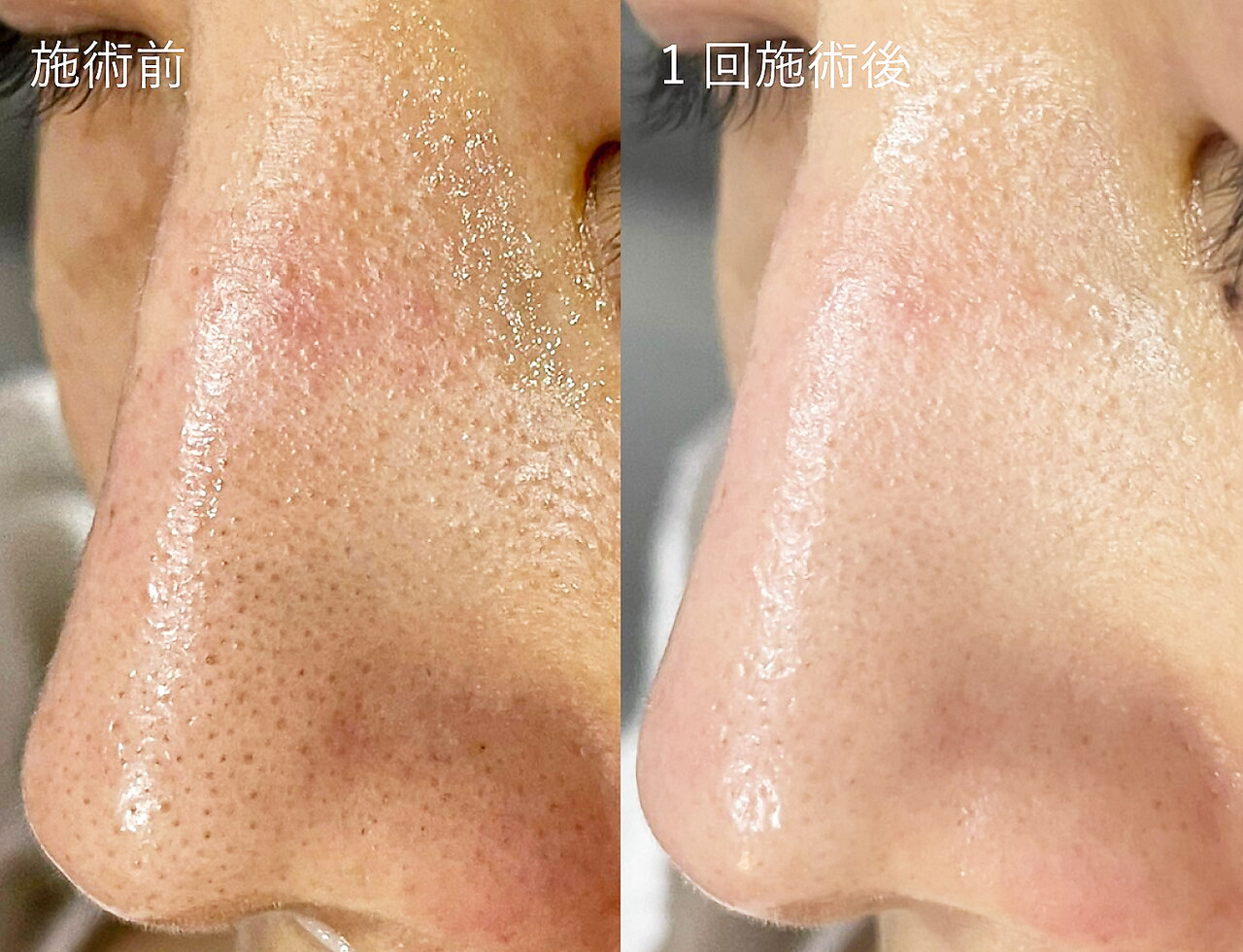 プラズマスター施術による小鼻まわりの毛穴の変化イメージ（仕上がり・実感には個人差があります）