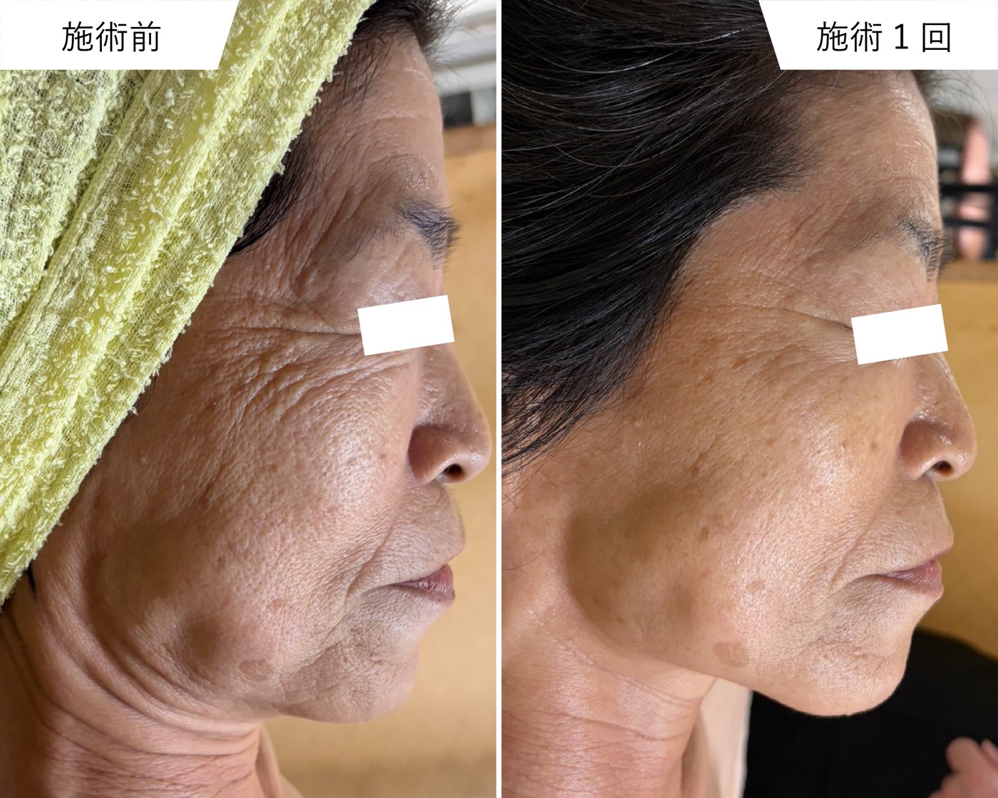 プラズマスターによるフェイスラインのエイジングケア 施術前と施術1回後の比較写真